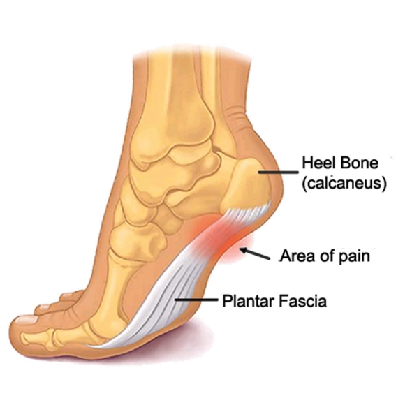 Acquired Flat Feet