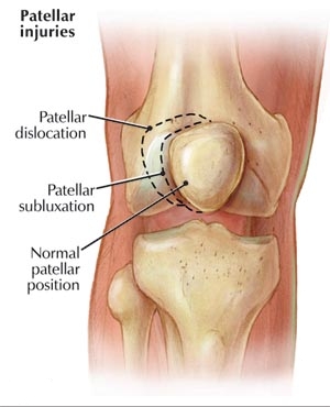 Patella Injuries